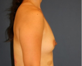 Feel Beautiful - Breast Augmentation 161 - Before Photo